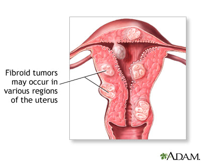 Fibroids Terminator Herbal Tea Blend
