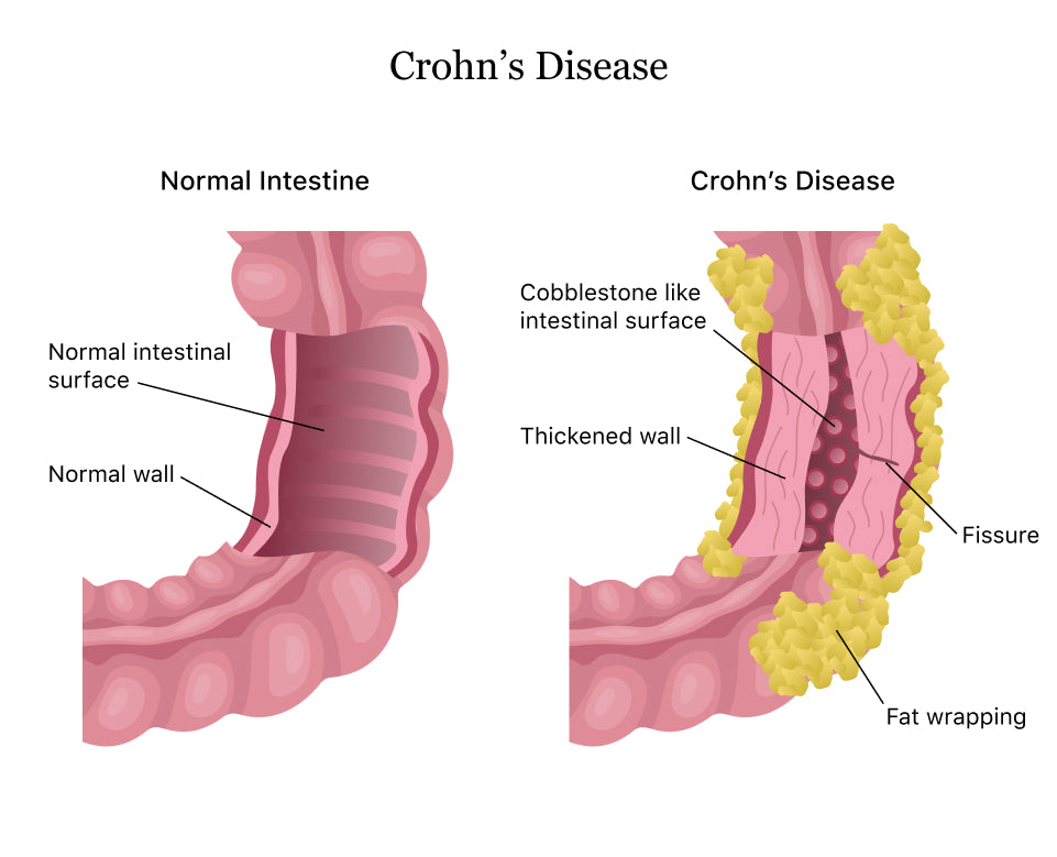 Crohn's Disease Relief Tea (loose herbs)
