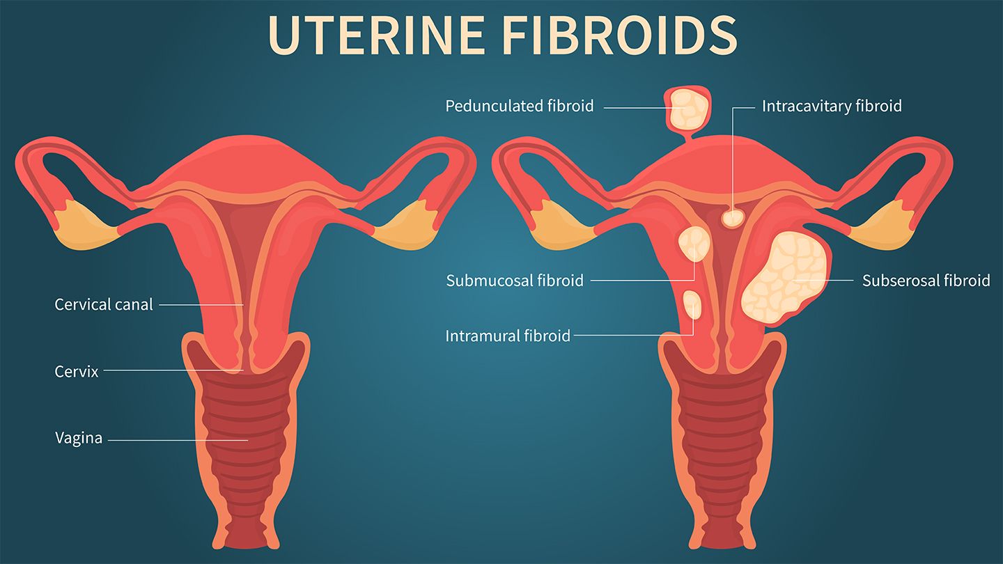 Fibroids Terminator Herbal Tea Blend
