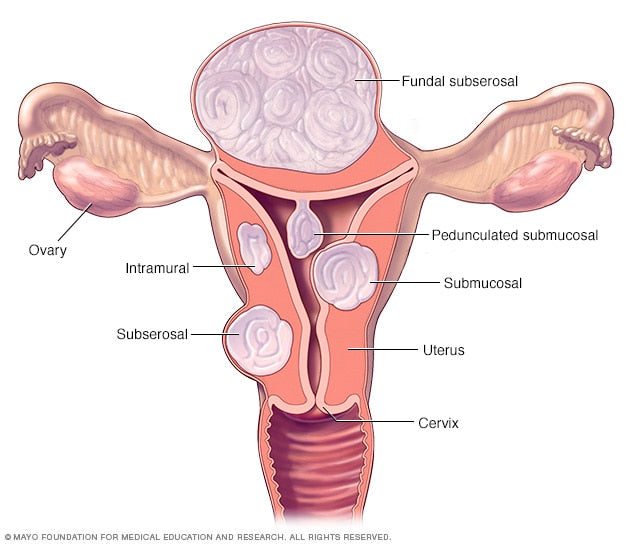 Fibroids Terminator Herbal Tea Blend