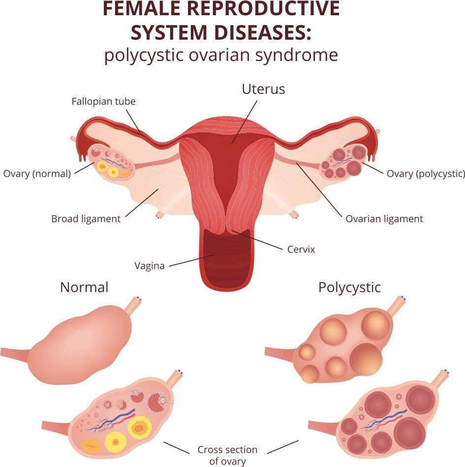 PCOS Destroyer Herbal Tea Blend - LattiesPalace